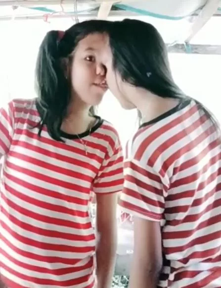 Joy and Joyce Magsino Conjoined twins